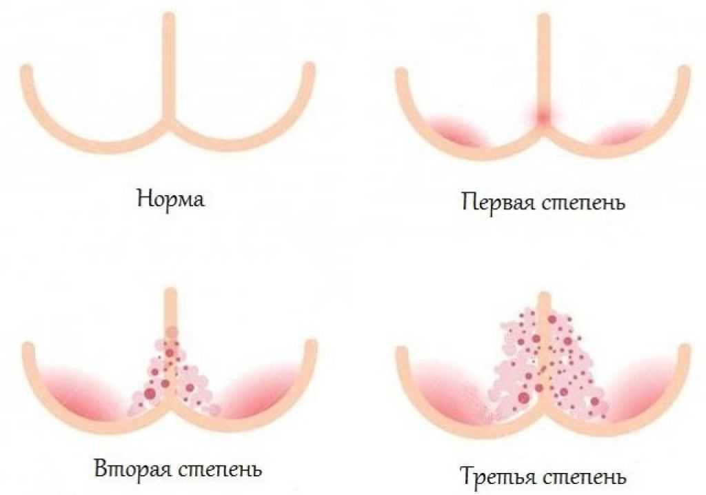 Все об опрелостях у новорожденных малышей: причины появления, эффективные методы профилактики и лечения