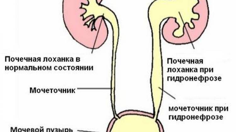 Расширение лоханки почки у новорожденного ребенка | moninomama.ru