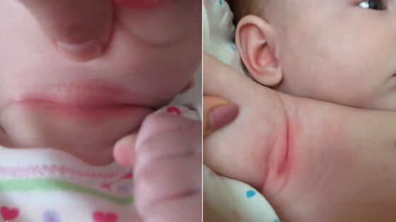 Что делать, если у ребенка шишечка на голове под кожей