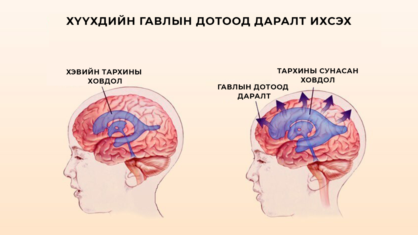 Внутричерепная гипертензия у детей: 10 симптомов, причины, диагностика и лечение