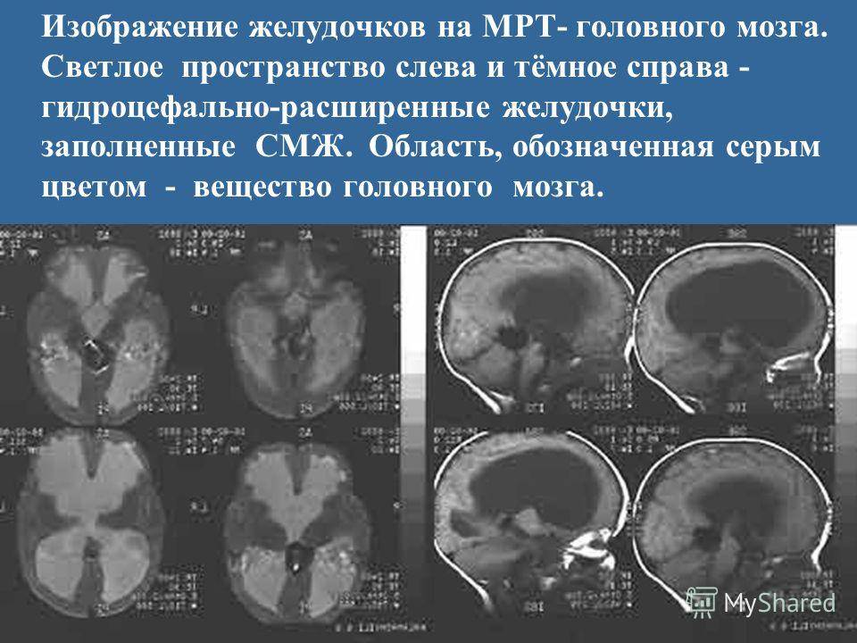 Норма желудочков мозга у взрослых. Гидроцефалия головного мозга на кт. Гидроцефалия желудочков головного мозга. Желудочки головного мозга при гидроцефалии. Мрт желудочков головного мозга в норме.