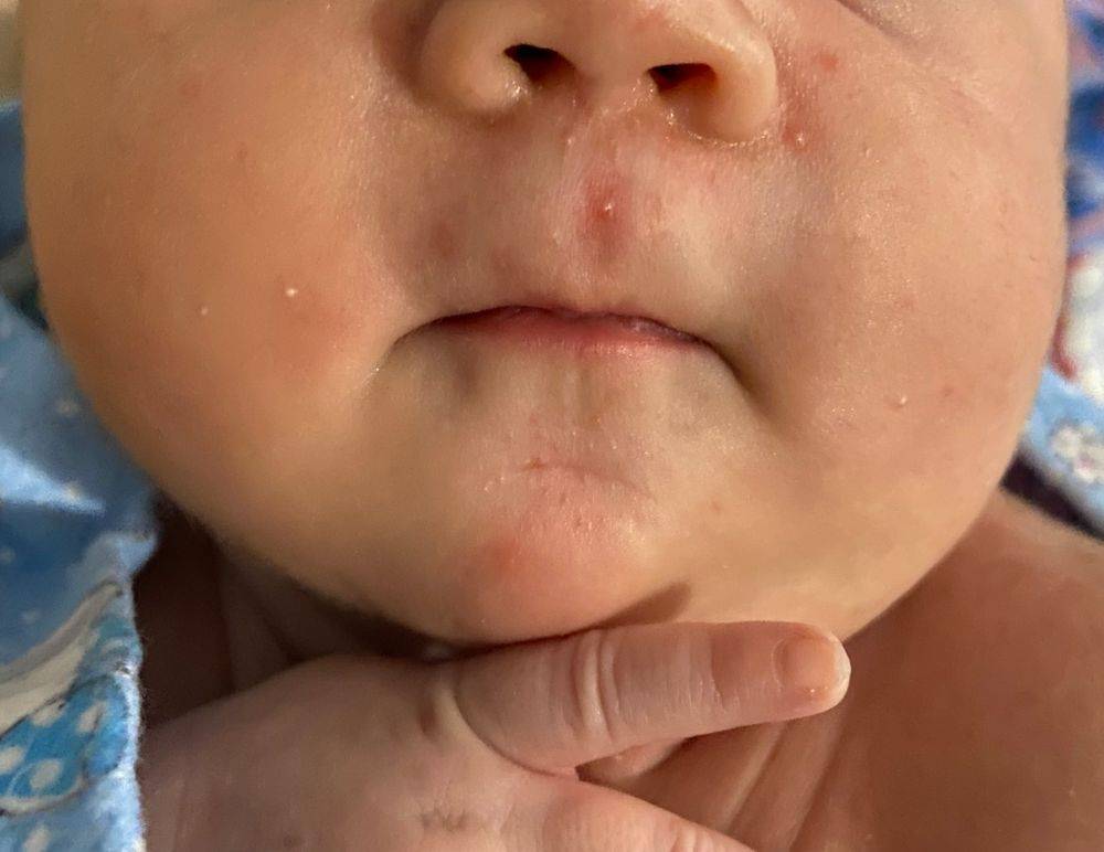 Прыщики на лице у новорожденного: причины, локализация высыпаний и сопутствующие симптомы, лечение