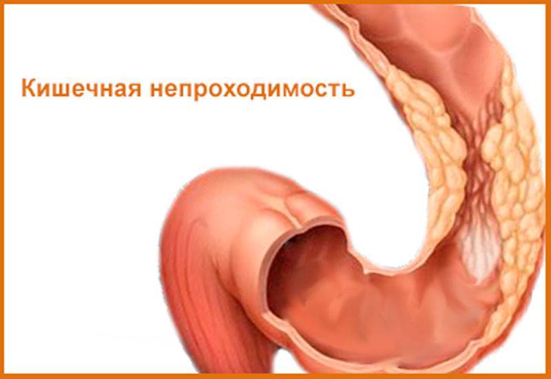 Кишечная непроходимость у детей