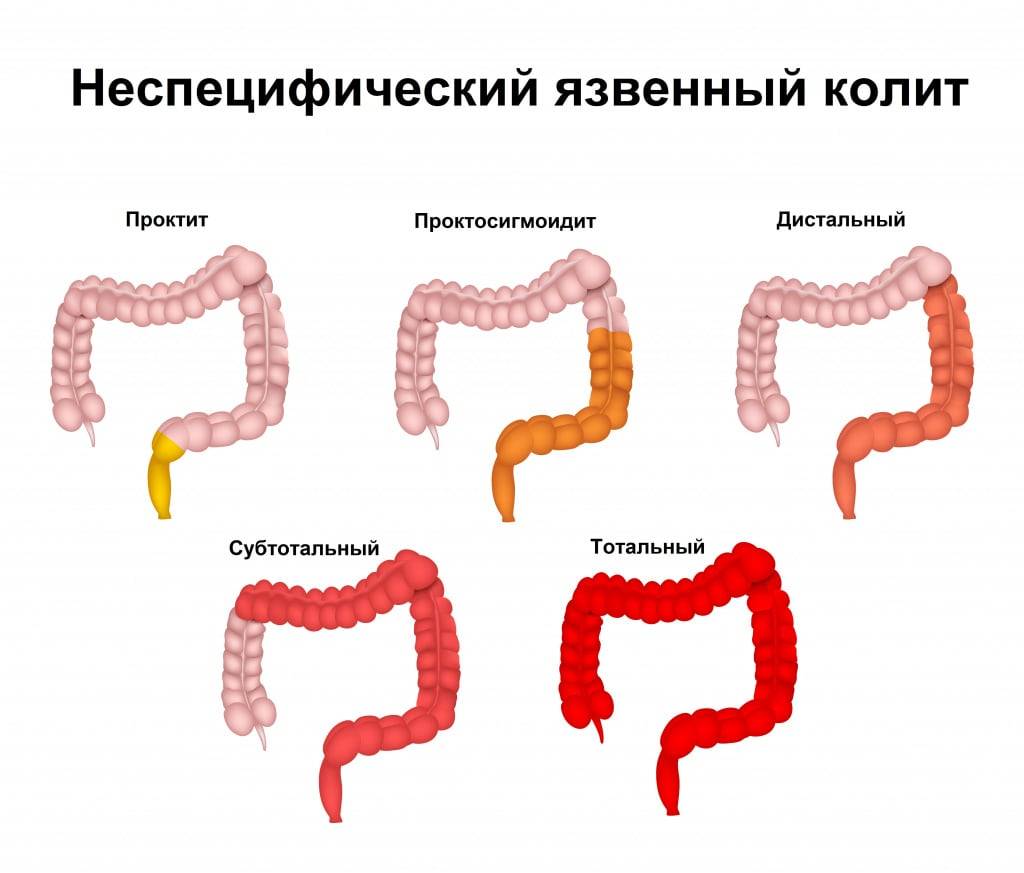 Кишечная колика у детей: симптомы и лечение - кишечные колики школьного возраста
