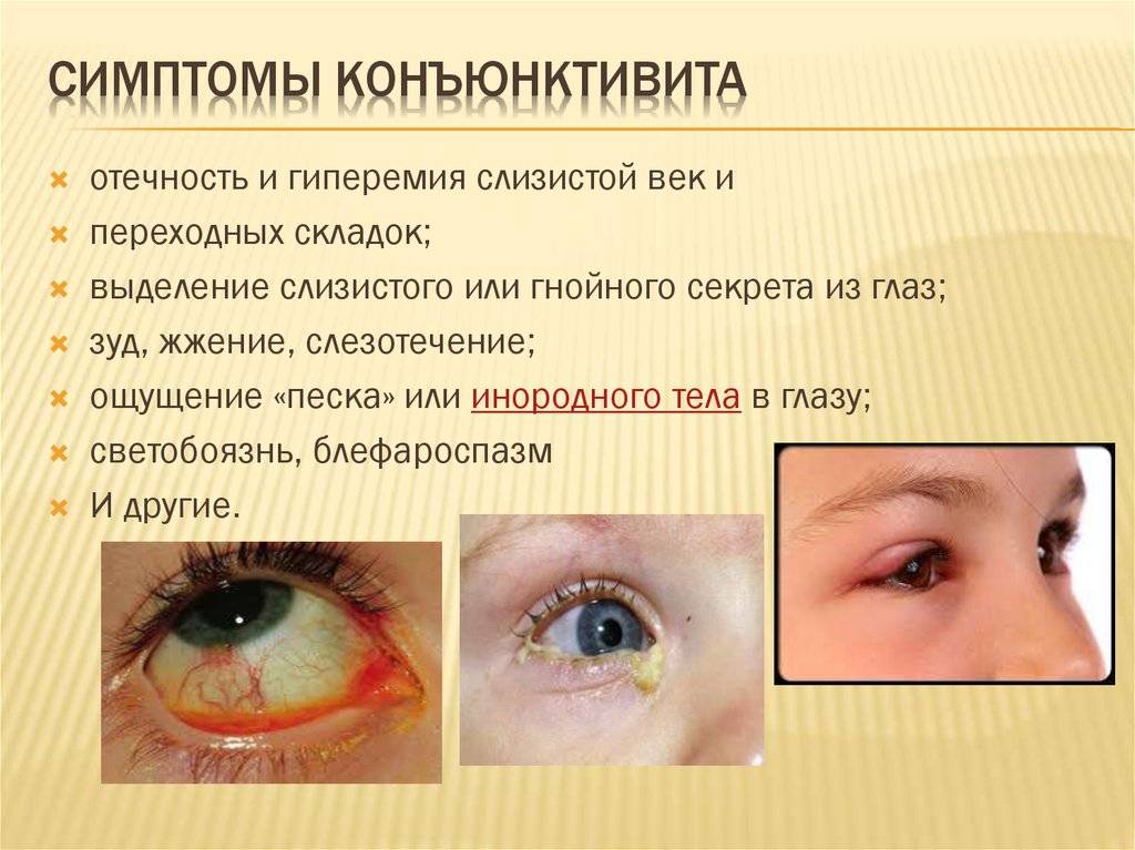 Почему у ребенка гноятся глаза? определяем основные причины самостоятельно
