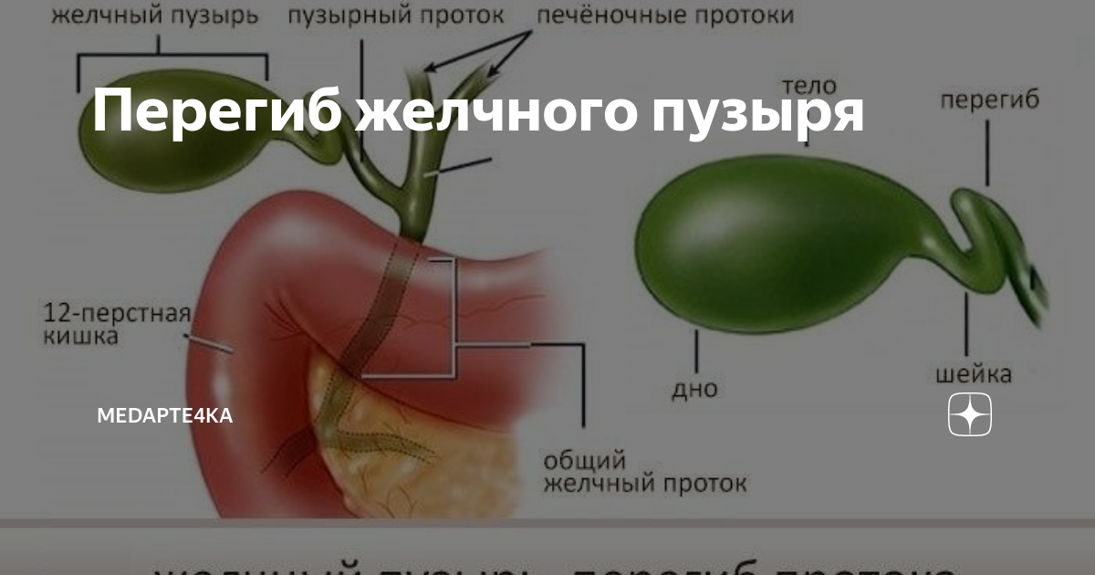 Загиб желчного пузыря у ребенка: классификация и причины, симптомы деформации, методы лечения и диагностики