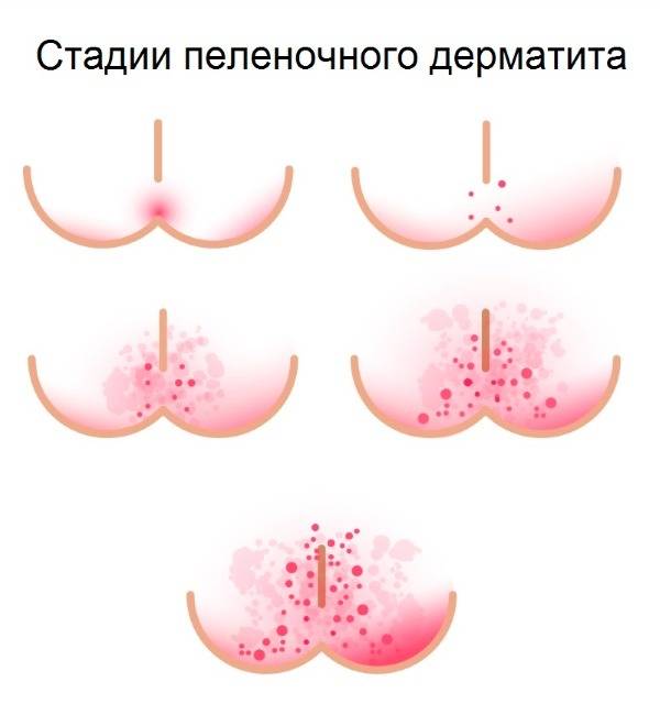 Как проявляется аллергия на подгузники: симптомы и фото раздражений, как выбрать памперсы ребенку