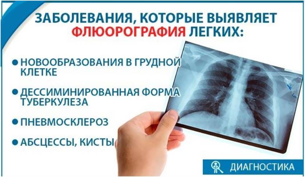 Где сделать рентген платно. Памятка по флюорографии. Патология легких на флюорографии. Памятка о прохождении флюорографии. Флюорография обследование.