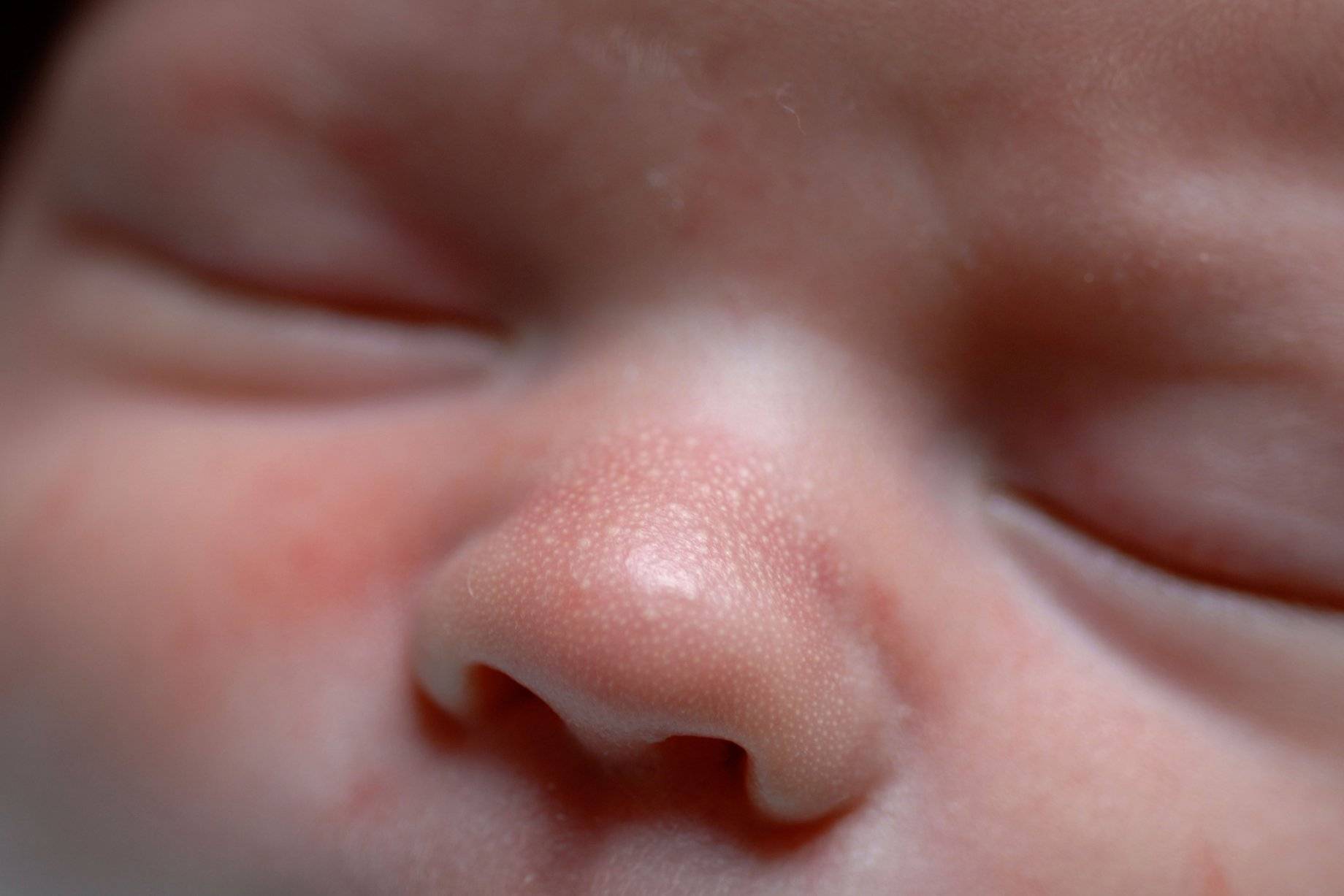 Сыпь у новорожденного и грудничка 📌 в виде прыщиков на лице и по всему телу: фото с пояснениями