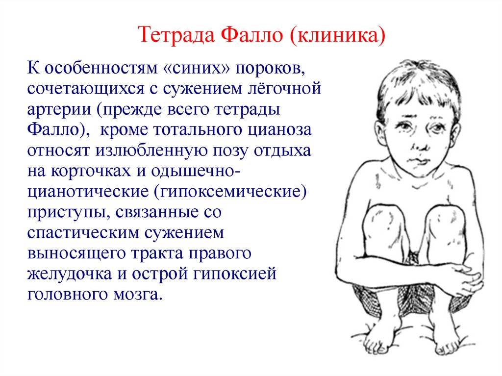 Цианоз носогубного треугольника: почему у грудничка или новорожденного синеет кожа вокруг рта?