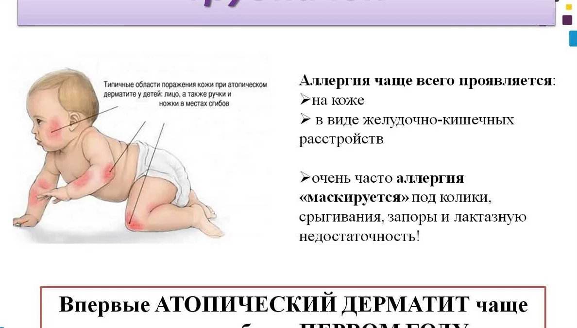 Через сколько проходит аллергия у грудничка: выясним максимальные и минимальные сроки