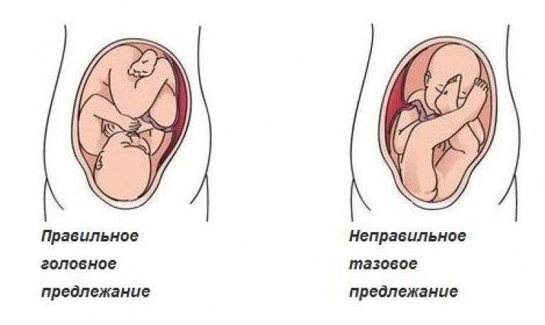 Тазовое предлежание плода. как узнать, как лежит ребенок в животе