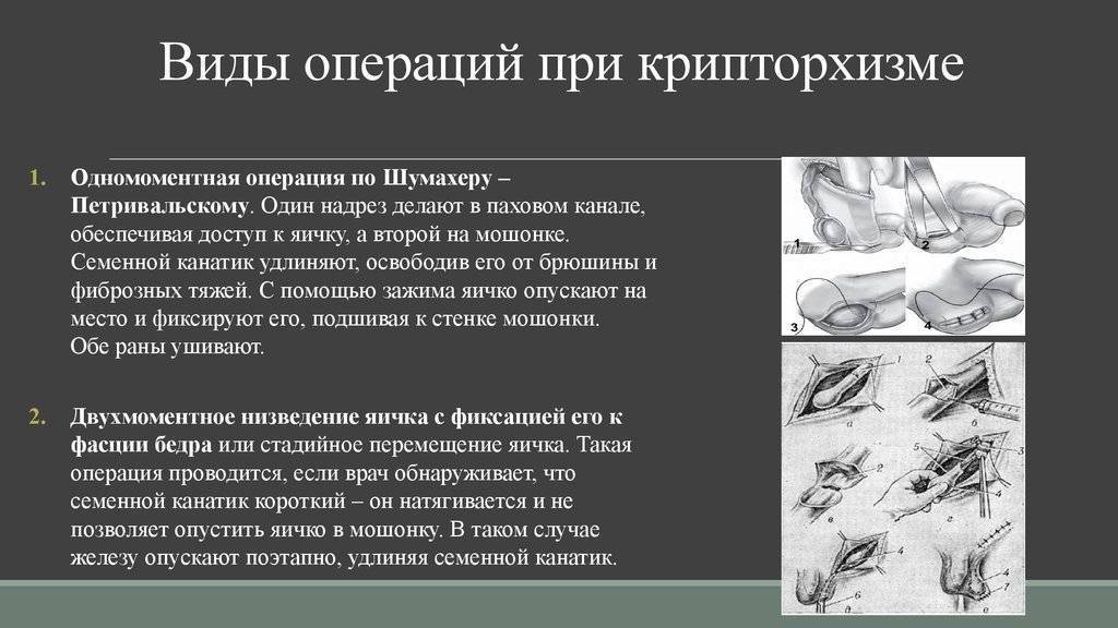 Что делать, если у новорождённого мальчика не опустились яички. причины и последствия