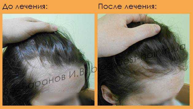 Выпадение волос после родов при кормлении грудью: причины, лечение - клиника «доктор волос»