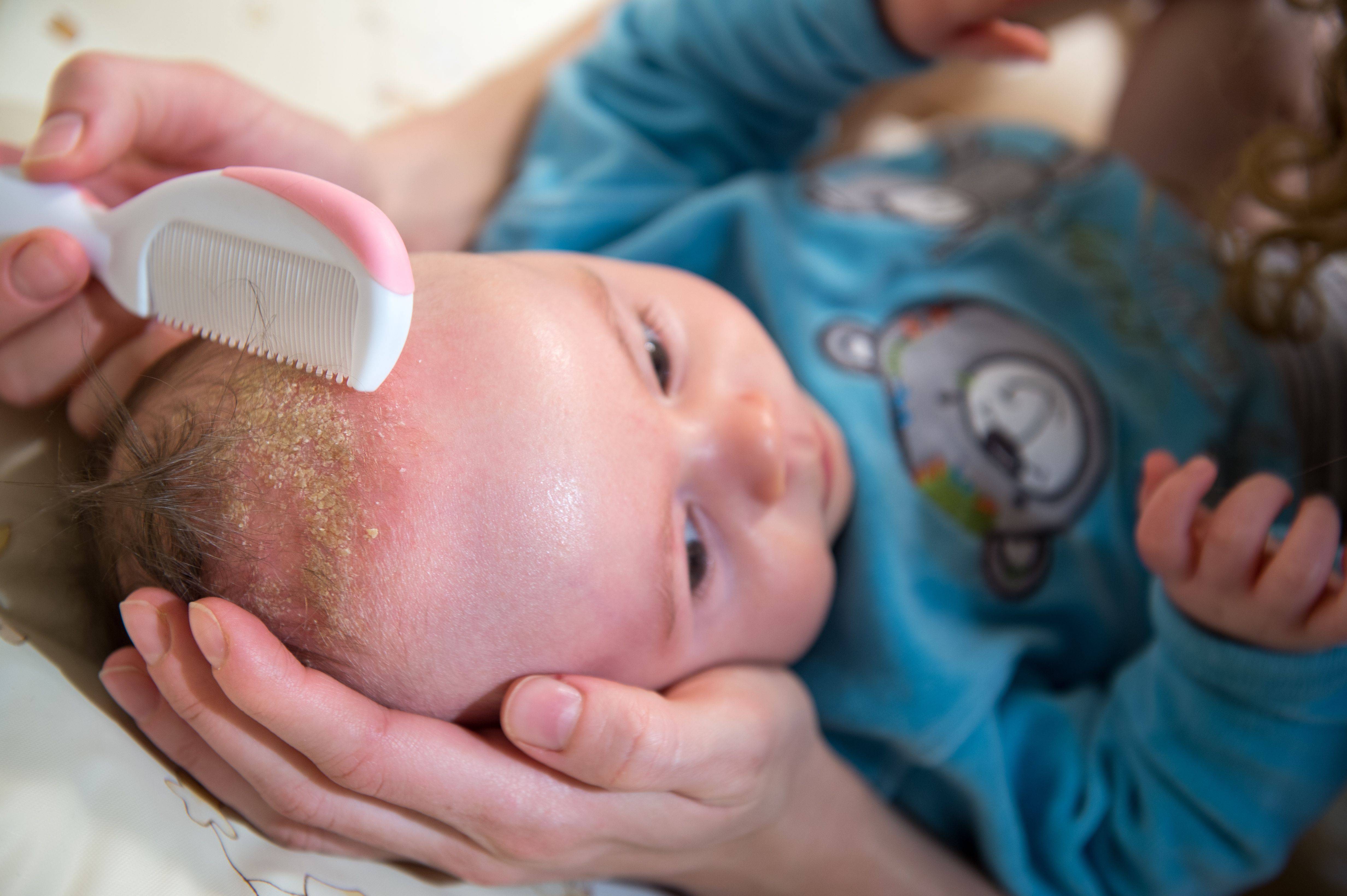 Шелушение кожи у новорожденных: причины и лечение