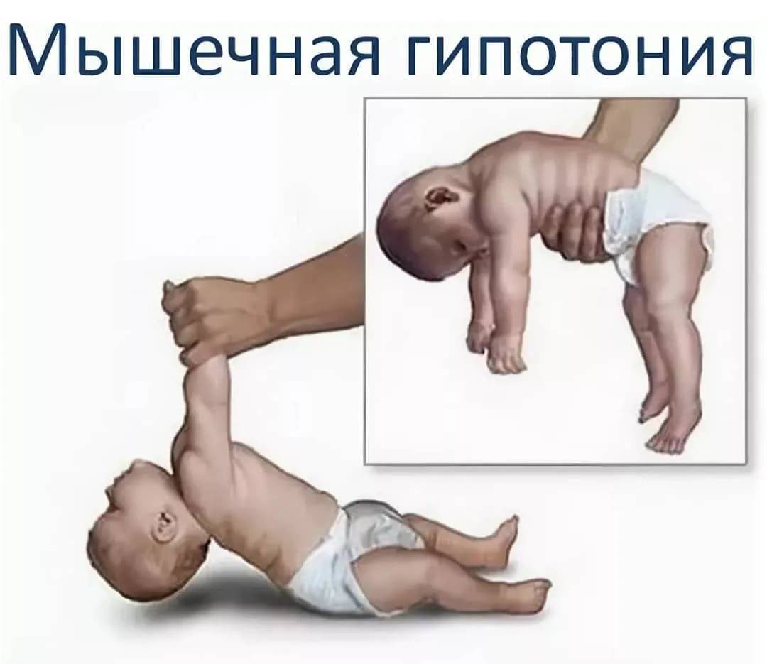 Синдром двигательных нарушений и дцп у грудничка