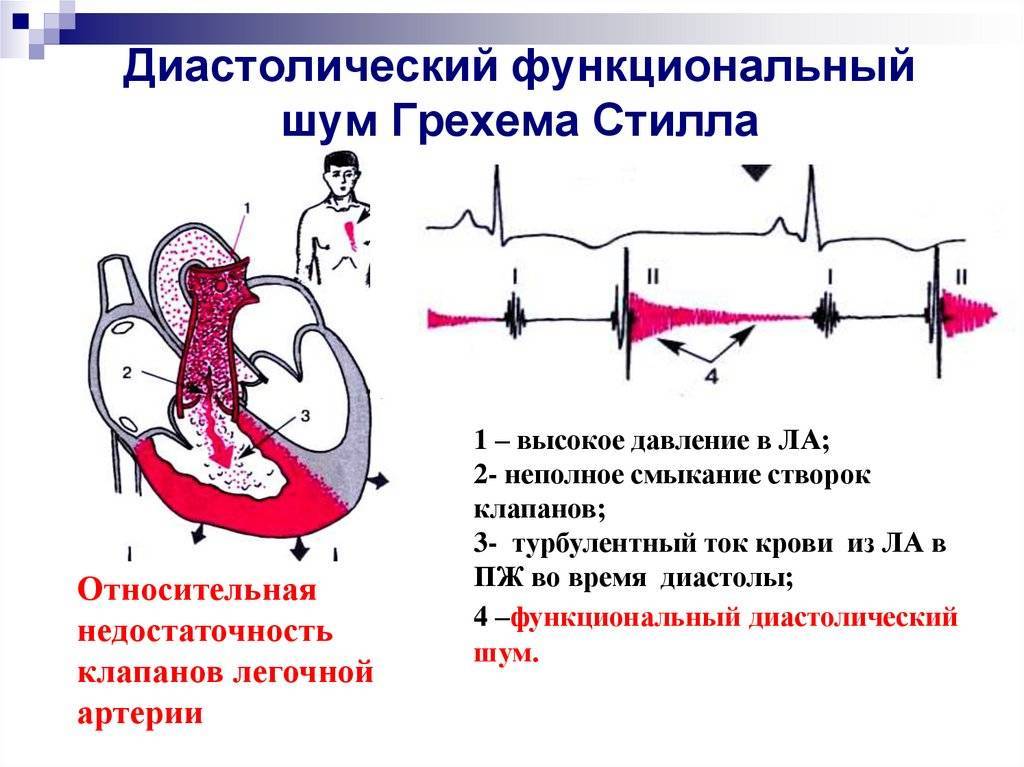 Причины возникновения шумов в сердце у новорожденного ребенка