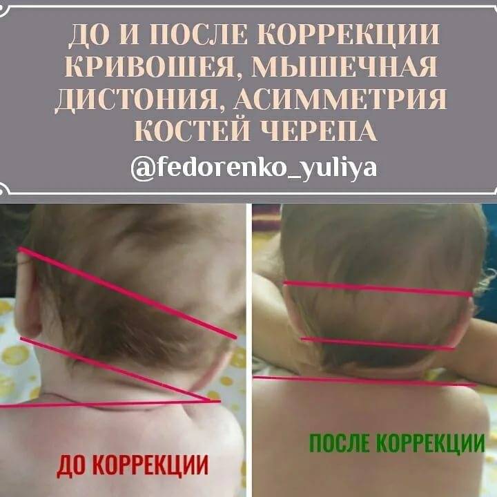 Шея Новорожденного Фото