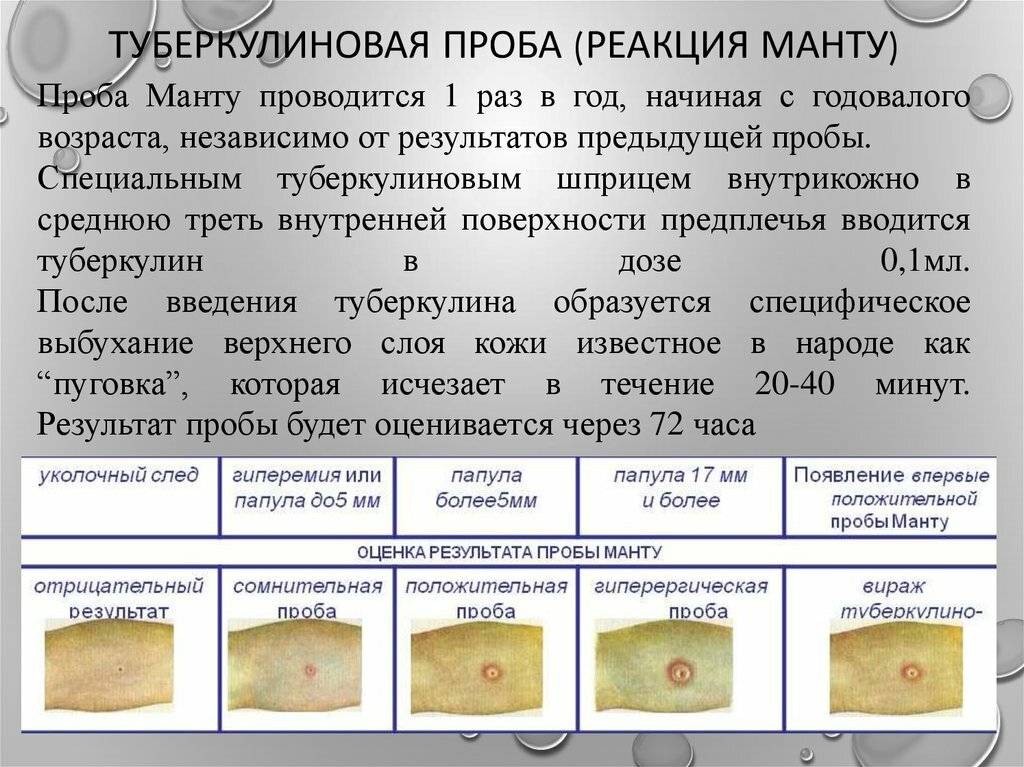 Можно ли делать манту при простудном заболевании: факторы влияющие на результаты диагностики туберкулеза