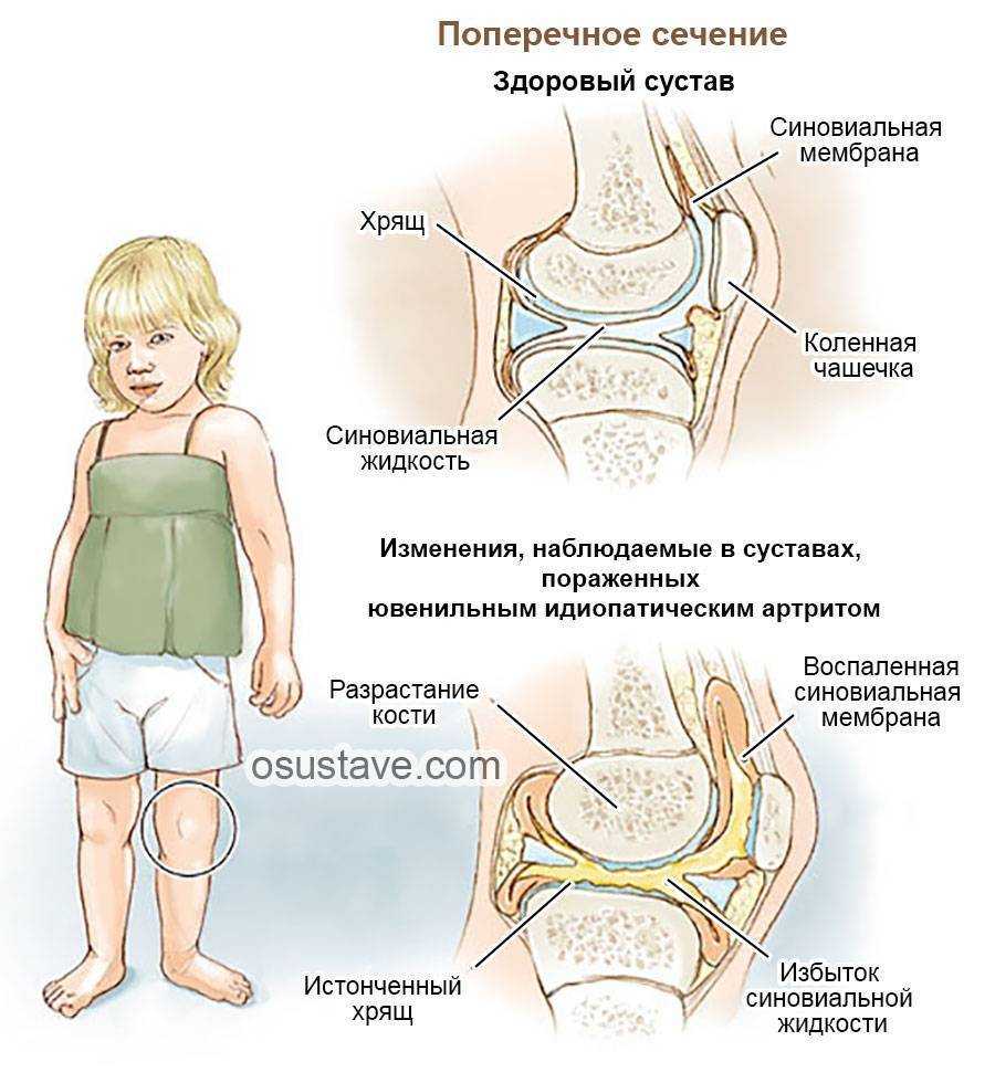 Ювенильный артрит у детей