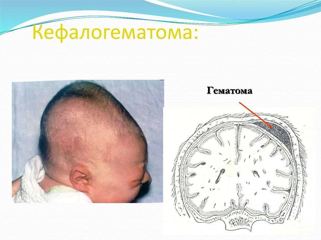 Кефалогематома на голове: способы лечения и последствия родовой травмы у новорожденных