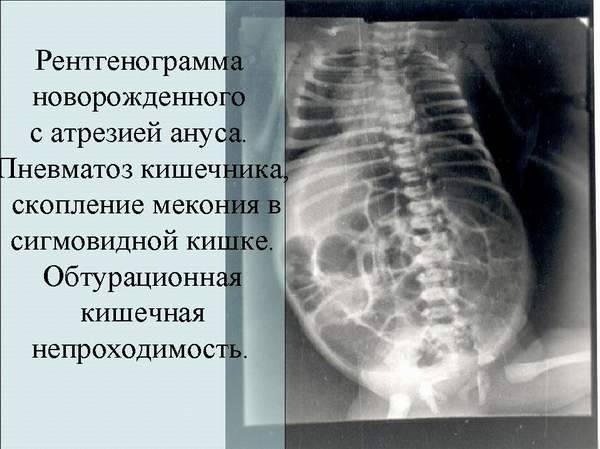 Атрезия пищевода у новорожденных детей: последствия, причины, симптомы, лечение, признаки