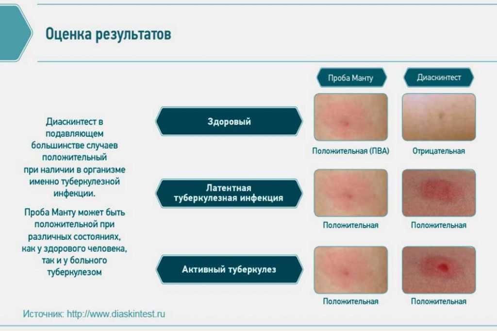 Можно ли делать манту при насморке