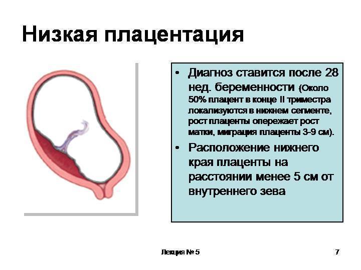 Низкая плацентация при беременности | аборт в спб