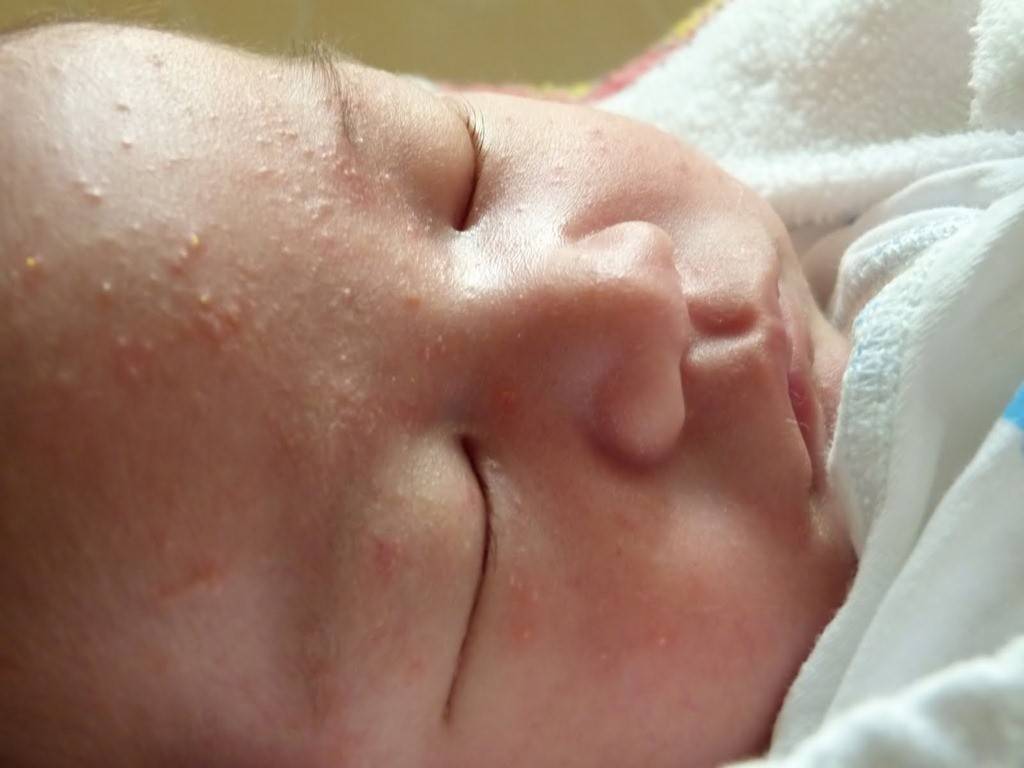 Прыщики на лице новорожденного ребенка: из-за чего появляются и что с ними делать