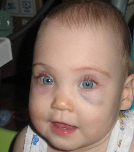 Синяки под глазами у ребёнка: причины и лечение