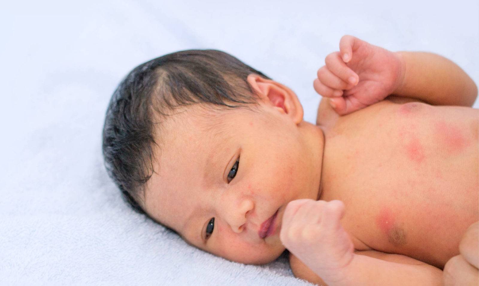 Токсическая эритема новорожденных: причины, лечение