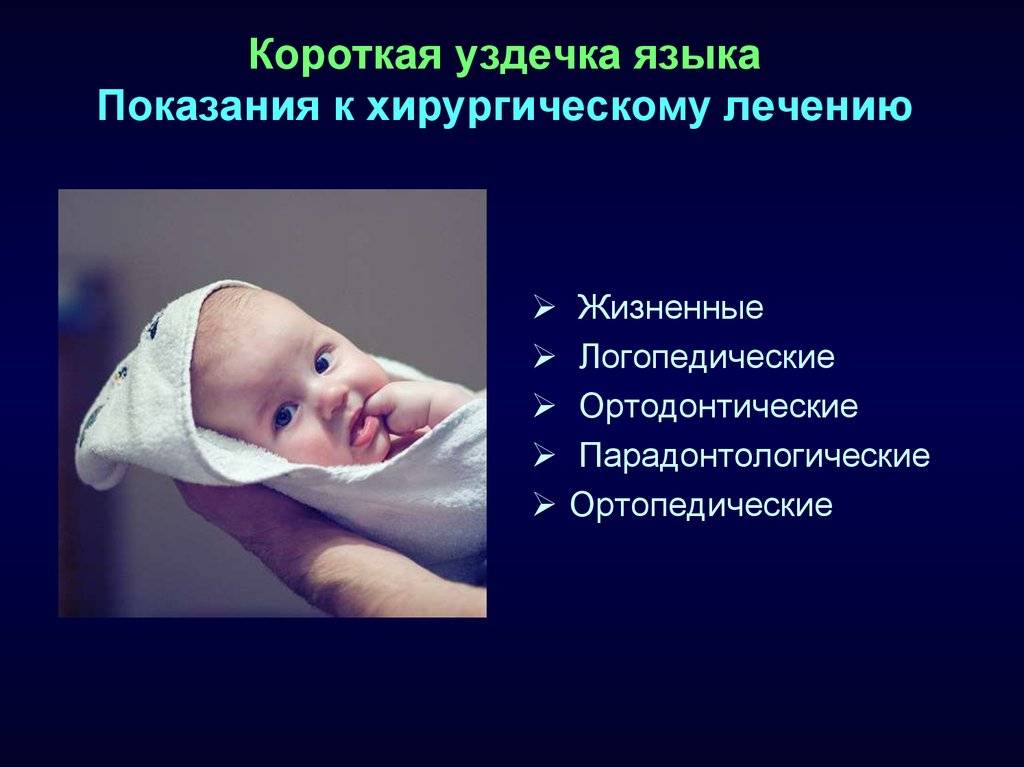 Короткая уздечка языка у ребенка: анкилоглоссия у новорожденных и грудничков