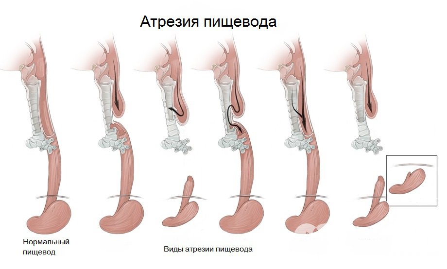 Атрезия пищевода у новорожденных: причины, симптомы и лечение