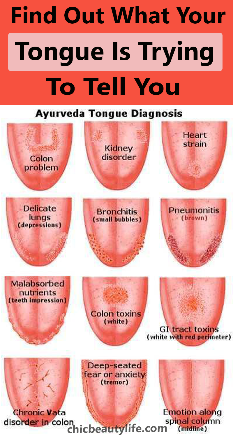 Виды цвета языка. Заболевания по цвету языка. Болезни по языку определить. Болезни по языку схема. Распознавание болезни по языку.