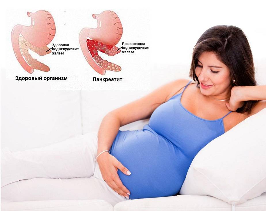 Хронический панкреатит во время беременности