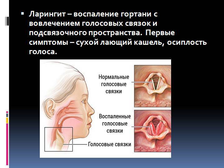 Ларингит карта вызова