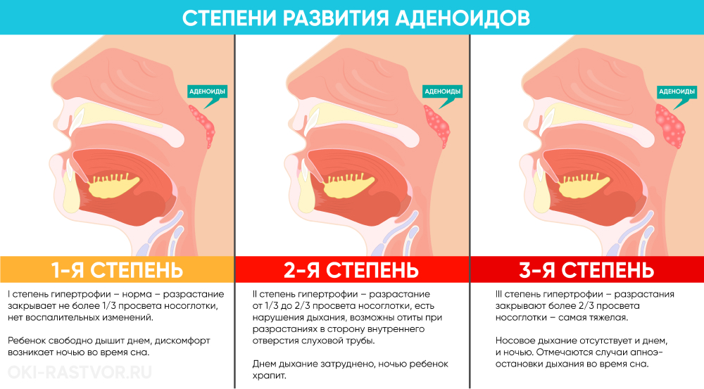 Хронический аденоидит у детей: 3 степени тяжести и направления терапии
