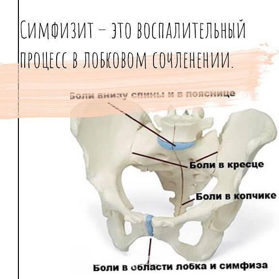 Симфизит при беременности: симптомы расхождения лонного сочленения у женщин, лечение и последствия