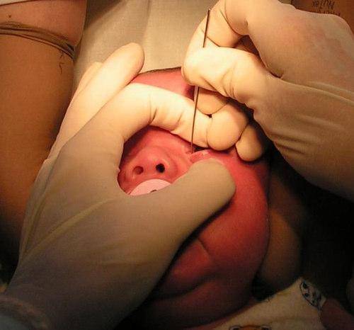 Зондирование слезного канала у новорожденных и детей до года при дакриоцистите