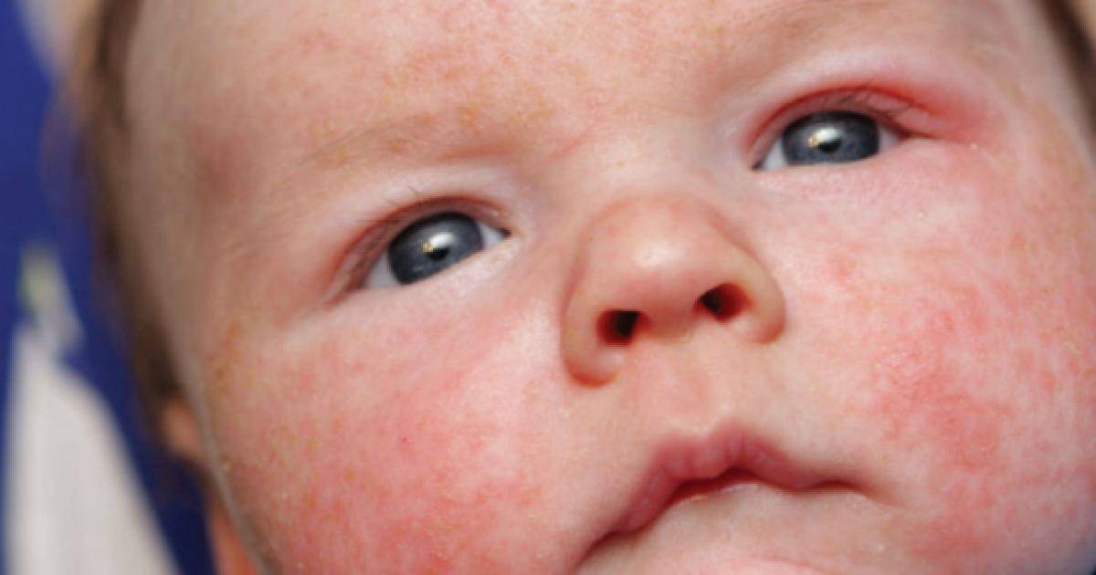 Как отличить потницу от аллергии у грудничка (новорожденного): основные различия - rodinkam.com