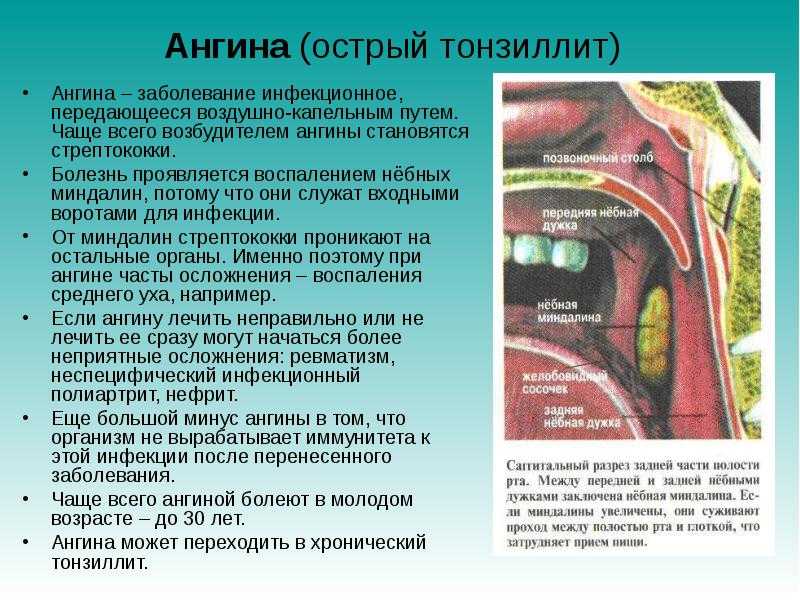 Ангина у грудного ребенка: лечение и профилактика
