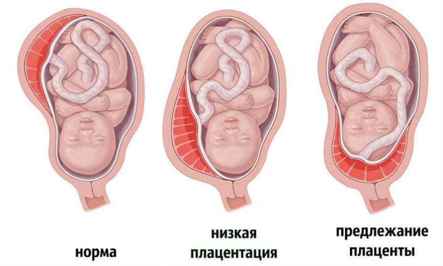 Низкое расположение плаценты