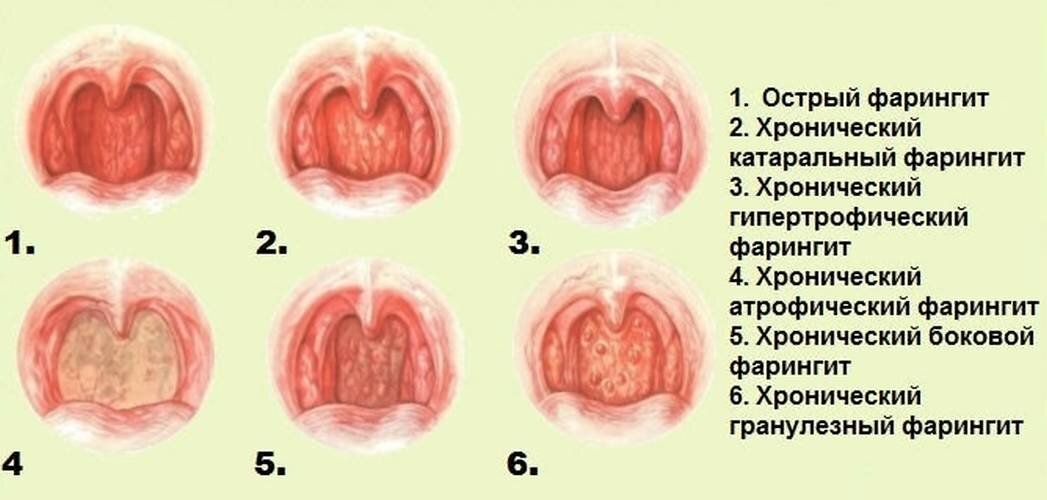 атрофический ларингит