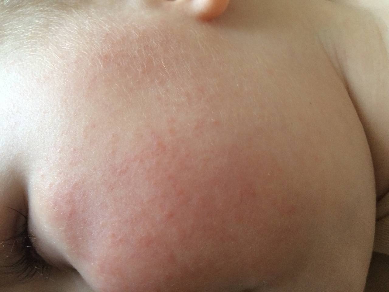 Основные отличия аллергии от потницы у младенцев