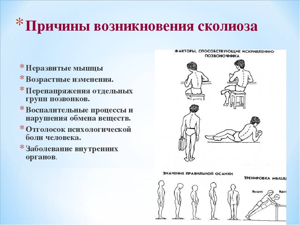 Сколиоз позвоночника у детей: причины, как лечить