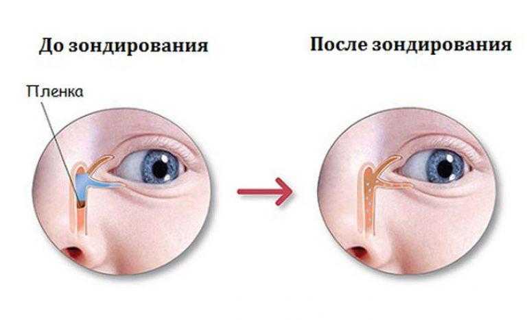 Промывание слезного канала у новорожденного - "здоровое око"