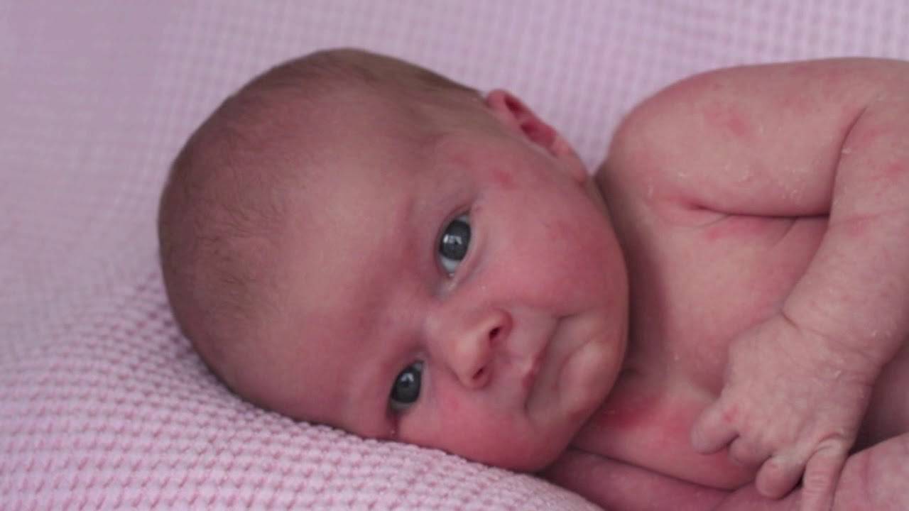 Почему синеет носогубный треугольник. Акроцианоз носогубный треугольник. Цианоз кожи у новорожденных. Красноватая кожа у новорожденных. Мраморность кожи у младенца.