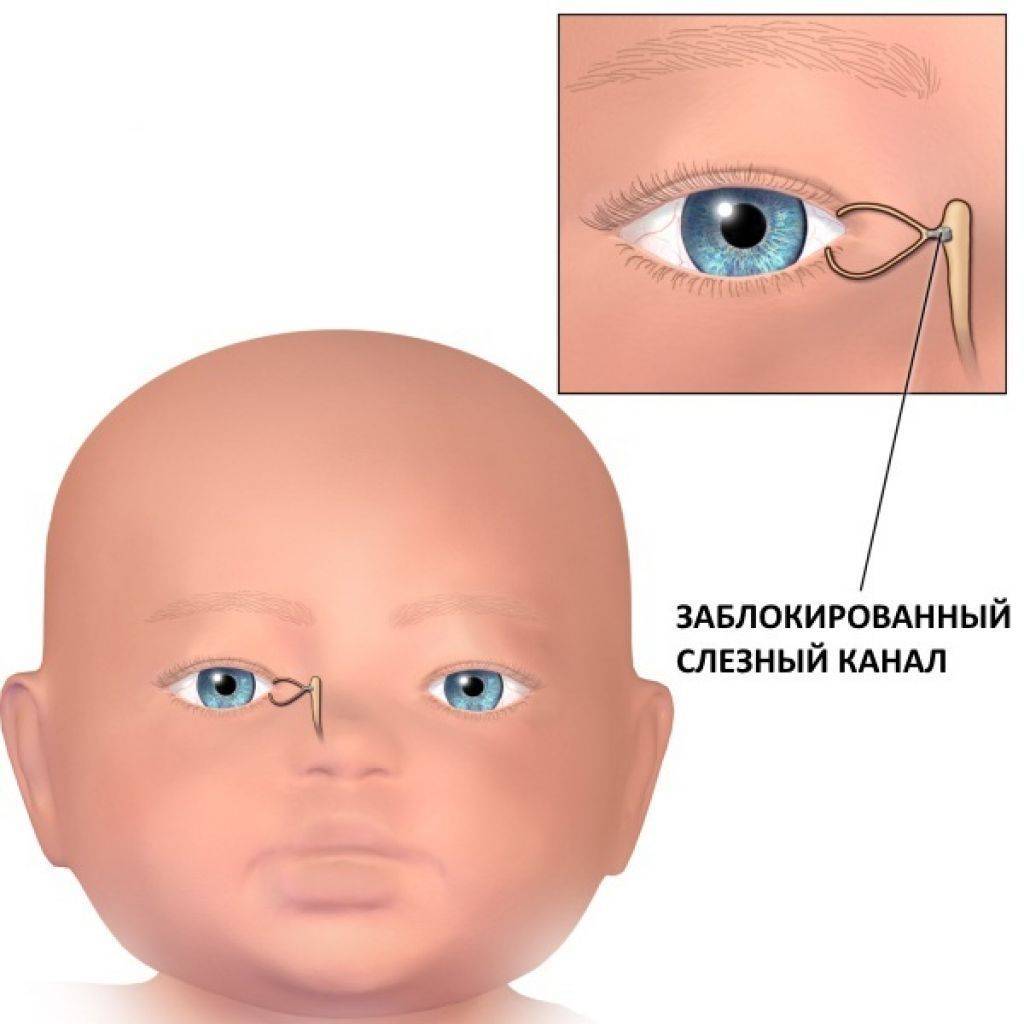 Непроходимость слезного канала у ребенка: симптомы и лечение