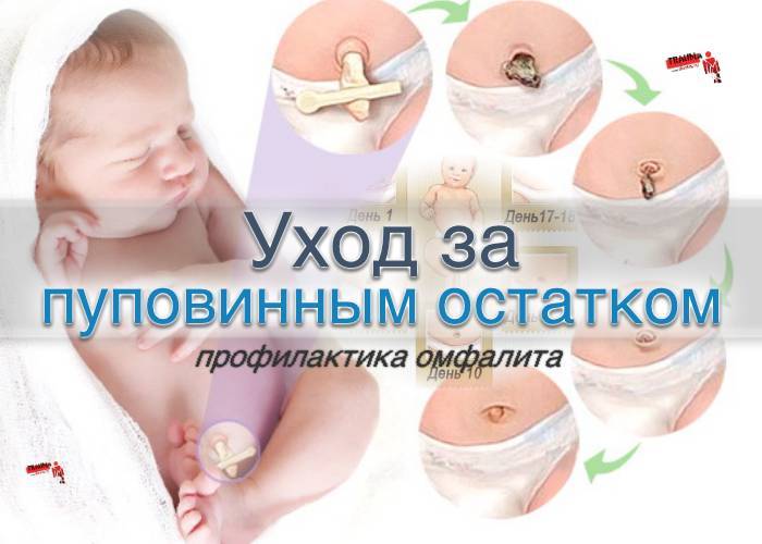 Обработка пупка новорождённого: как помочь и не навредить