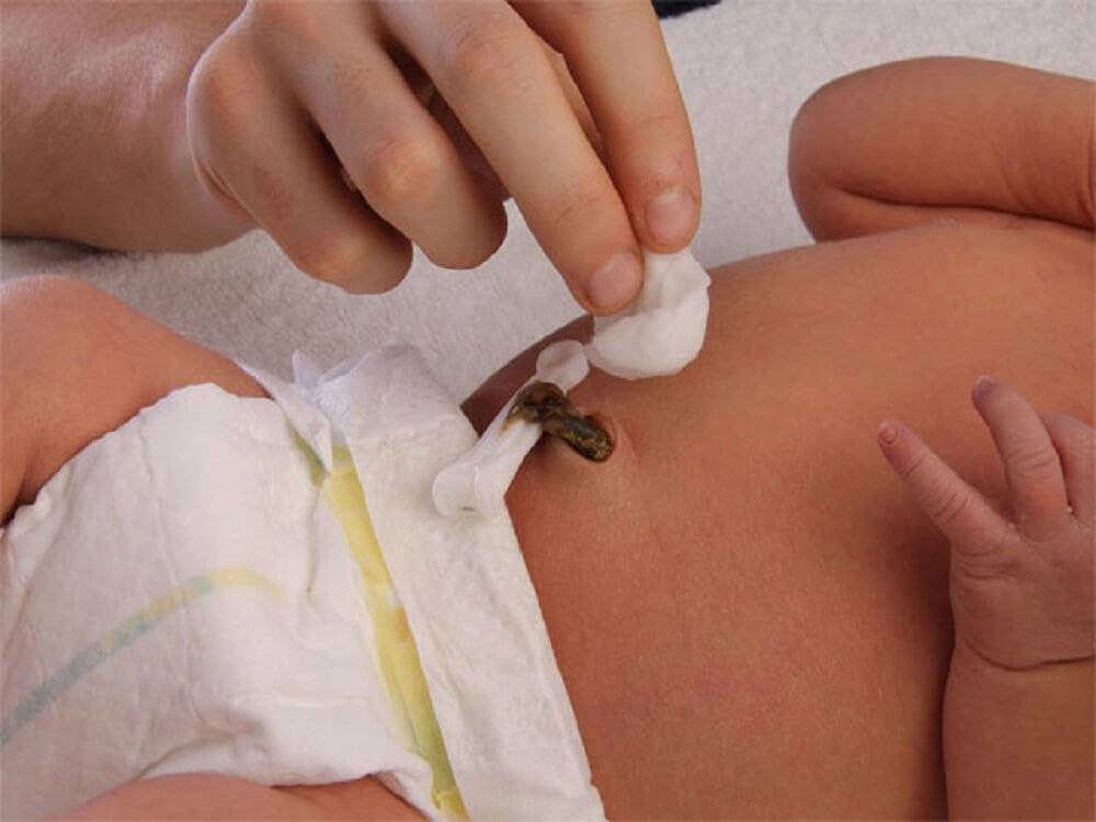 Кровит пупок у новорожденного: что делать